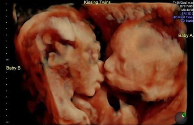 超生检查，罕见发现双胞胎在肚子里互相亲吻